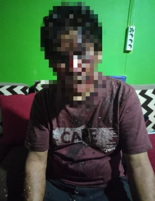 Diduga Pembiaran Penanganan Kasus Pengeroyokan Anwar Gayo Pengusa Kopi Di Desa Warnasari