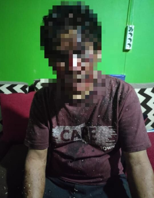 Diduga Pembiaran Penanganan Kasus Pengeroyokan Anwar Gayo Pengusa Kopi Di Desa Warnasari